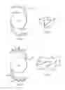 Fig. 04 - INTRAOCULAR LENS