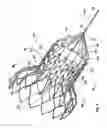 Fig. 07 - Devices and methods for collapsing prosthetic heart valves