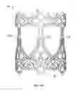 Fig. 02 - Collapsible prosthetic heart valves