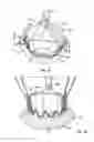 Fig. 56 - Collapsible prosthetic heart valves