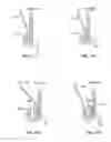 Fig. 68 - Collapsible prosthetic heart valves