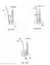 Fig. 69 - Collapsible prosthetic heart valves