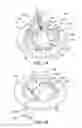 Fig. 02 - Prosthetic heart valve with retention elements