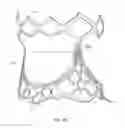 Fig. 06 - Collapsible prosthetic heart valves