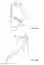 Fig. 20 - Collapsible prosthetic heart valves