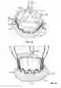 Fig. 56 - Collapsible prosthetic heart valves
