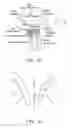 Fig. 02 - Heart valve assistive prosthesis