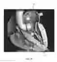 Fig. 07 - Heart valve assistive prosthesis