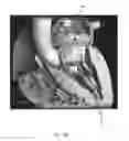 Fig. 08 - Heart valve assistive prosthesis