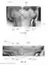Fig. 22 - Heart valve assistive prosthesis
