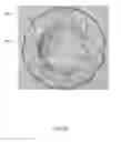 Fig. 24 - Heart valve assistive prosthesis