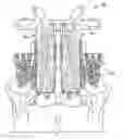 Fig. 01 - Shapeable porous metal implant