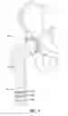 Fig. 04 - Shapeable porous metal implant