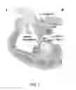 Fig. 03 - IBD Expandable Ti