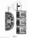 Fig. 08 - IBD Expandable Ti