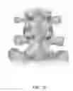 Fig. 11 - IBD Expandable Ti