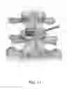 Fig. 12 - IBD Expandable Ti