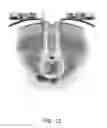Fig. 13 - IBD Expandable Ti