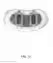 Fig. 14 - IBD Expandable Ti