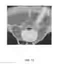 Fig. 15 - IBD Expandable Ti