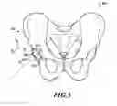 Fig. 05 - Devices and methods for hip replacement