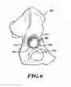 Fig. 06 - Devices and methods for hip replacement