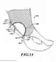 Fig. 10 - Devices and methods for hip replacement