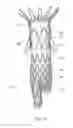 Fig. 10 - Low profile non-symmetrical stent