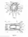 Fig. 11 - Low profile non-symmetrical stent