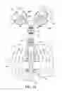 Fig. 03 - Thoracic lumbar sacral orthosis