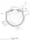 Fig. 22 - Therapeutic agent delivery device with advanceable cannula and needle