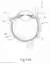 Fig. 24 - Therapeutic agent delivery device with advanceable cannula and needle