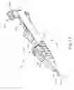 Fig. 30 - Therapeutic agent delivery device with advanceable cannula and needle