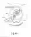Fig. 11 - Motorized suprachoroidal injection of therapeutic agent