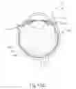 Fig. 22 - Motorized suprachoroidal injection of therapeutic agent