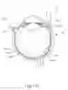 Fig. 25 - Motorized suprachoroidal injection of therapeutic agent