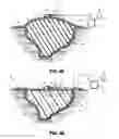 Fig. 04 - Shear resistant wound dressing for use in vacuum wound therapy