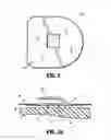 Fig. 07 - Shear resistant wound dressing for use in vacuum wound therapy