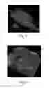 Fig. 05 - Nonwoven material having discrete three-dimensional deformations with wide base openings