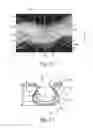 Fig. 07 - Nonwoven material having discrete three-dimensional deformations with wide base openings