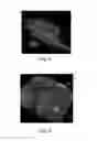 Fig. 05 - Nonwoven material having discrete three-dimensional deformations with wide base openings and specific fiber concentrations