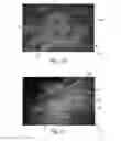 Fig. 11 - Nonwoven material having discrete three-dimensional deformations with wide base openings and specific fiber concentrations