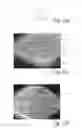 Fig. 17 - Nonwoven material having discrete three-dimensional deformations with wide base openings and specific fiber concentrations