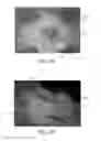 Fig. 12 - Nonwoven Material Having Discrete Three-Dimensional Deformations Forming Protrusions Having A Varying Width And Wide Base Openings