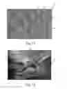 Fig. 08 - Nonwoven Material Having Discrete Three-Dimensional Deformations With Wide Base Openings That are Tip Bonded to Additional Layer
