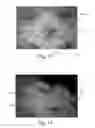 Fig. 12 - Nonwoven Material Having Discrete Three-Dimensional Deformations With Wide Base Openings That are Tip Bonded to Additional Layer