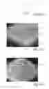 Fig. 17 - Nonwoven Material Having Discrete Three-Dimensional Deformations With Wide Base Openings That are Tip Bonded to Additional Layer