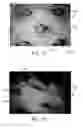 Fig. 12 - Absorbent Articles