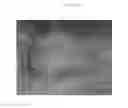 Fig. 02 - Emulsions or microemulsions for use in endoscopic mucosal resectioning and/or endoscopic submucosal dissection