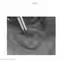 Fig. 07 - Emulsions or microemulsions for use in endoscopic mucosal resectioning and/or endoscopic submucosal dissection
